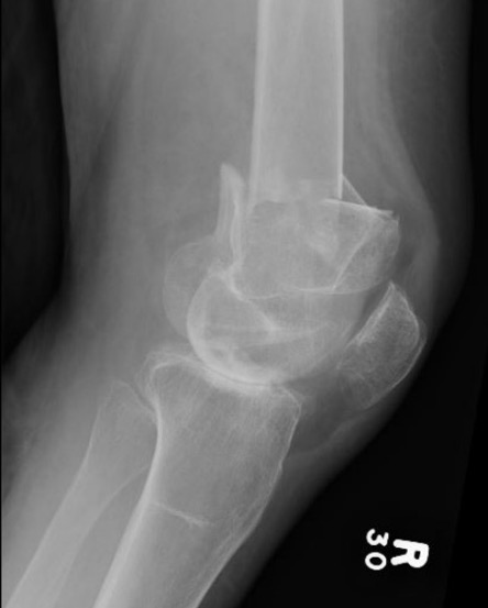 Distal Femur Replacement 2